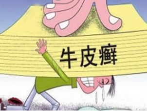 牛皮癣能治好吗